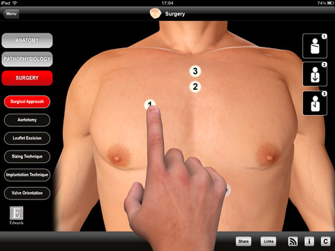 Aort Darlığı iPad’de