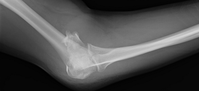 Cebinizdeki Röntgen Cihazı: FractureDx