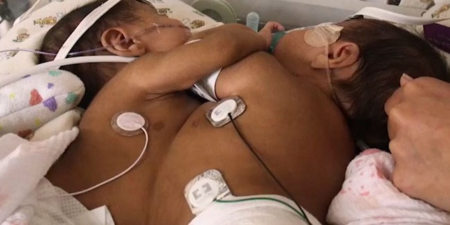 Doktorlar Siyam İkizlerinin Hayatını Sanal Gerçeklik Yardımıyla Kurtardılar