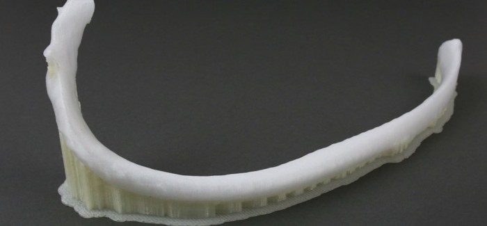 3D Yazıcı ile Kaburga Kemiği Üretildi
